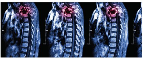Radiofrequency of Spinal Metastases - Comprehensive Integrated Care